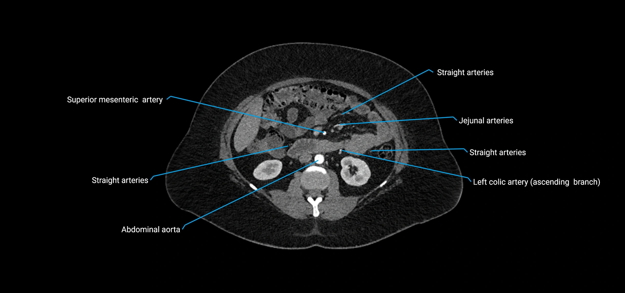 CTA abdomen axial cross sectional anatomy labelled image_87 (2).webp
